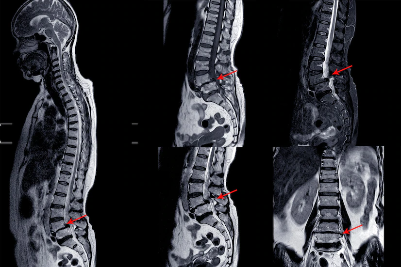 Lumbar Laminectomy surgery